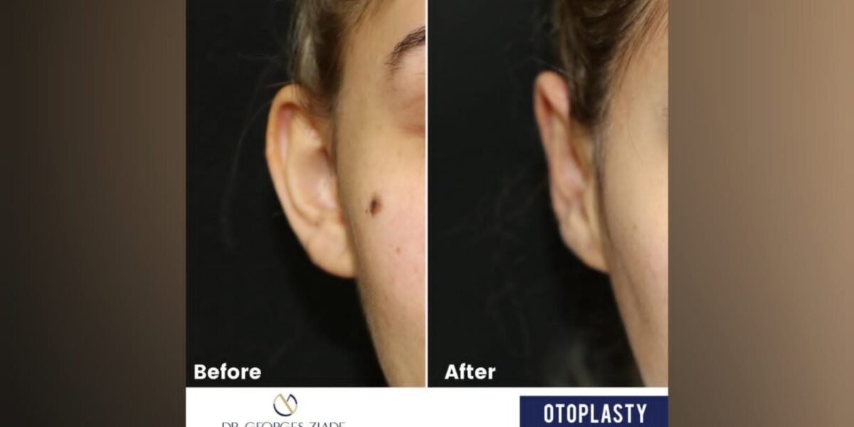 جورج زيادة يتطرق الى عملية “Otoplasty”