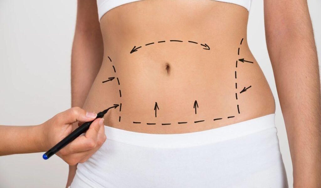 دكتور التجميل علي عبد علي يسلط الضوء على عملية شفط الدهون