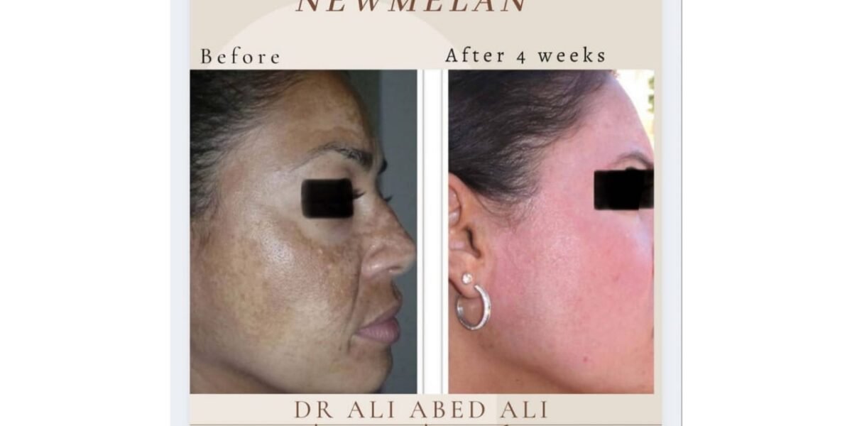 دكتور التجميل “ali abedali” و تقنية “newmelan pigmentation”